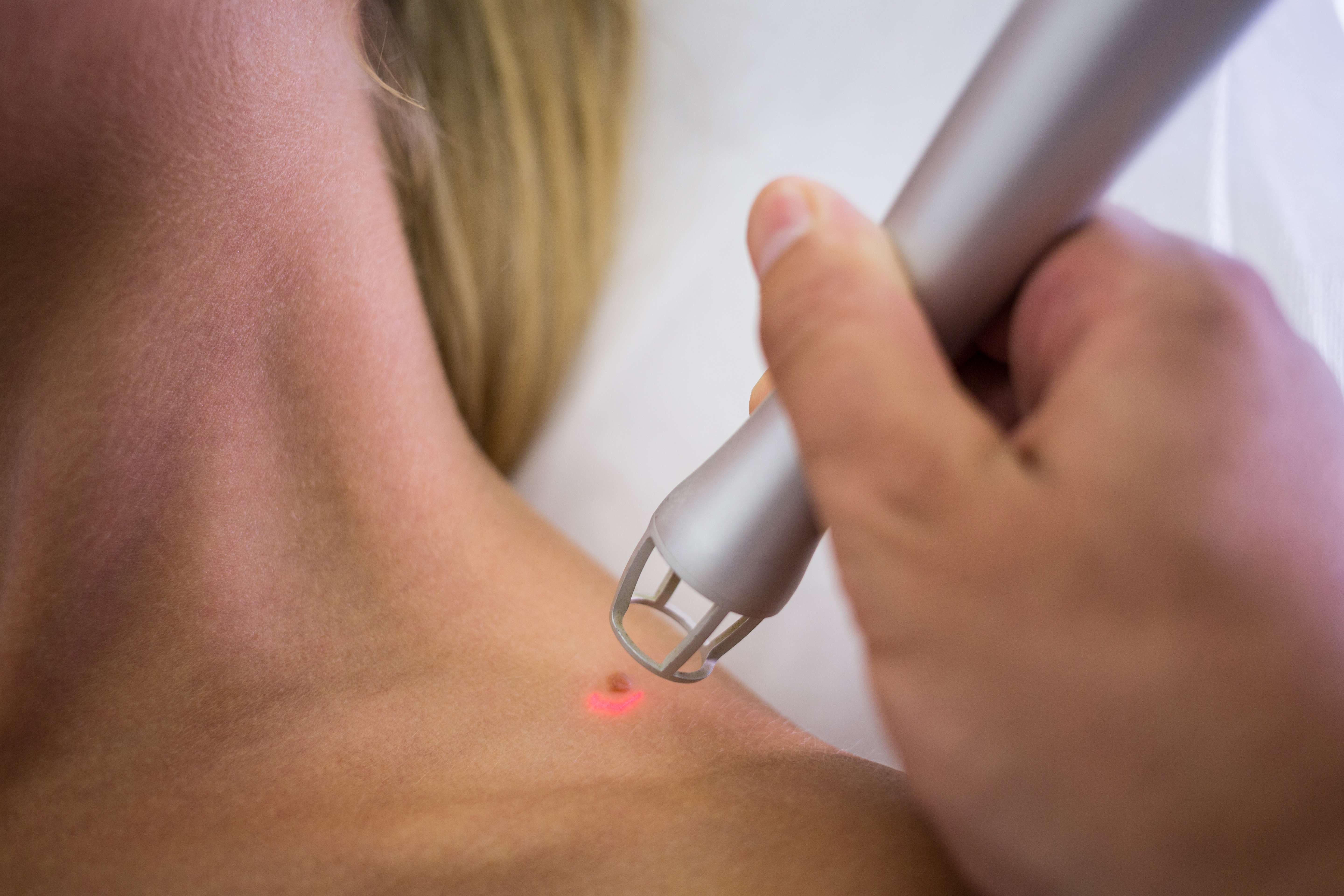 mole removal