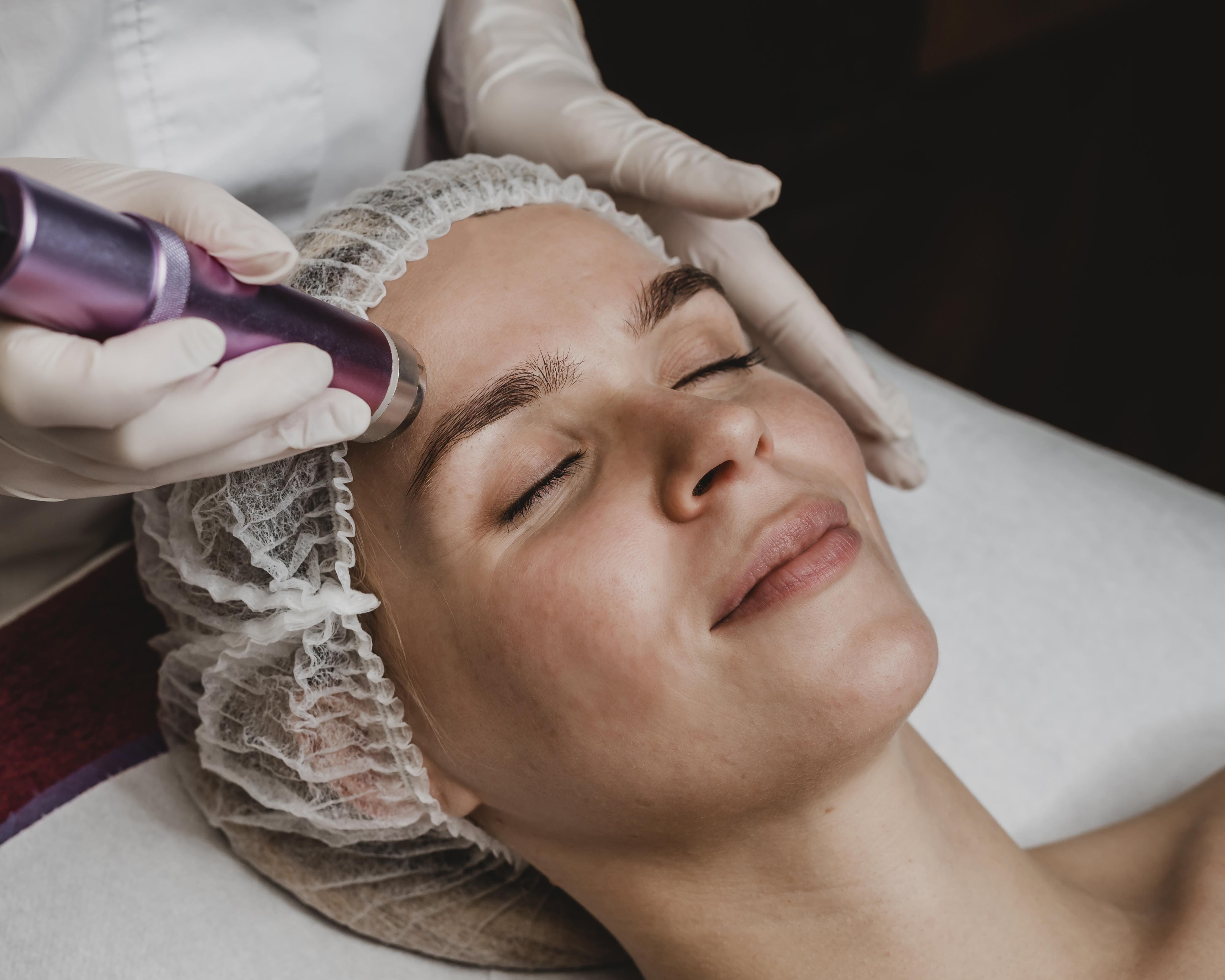 microneedling